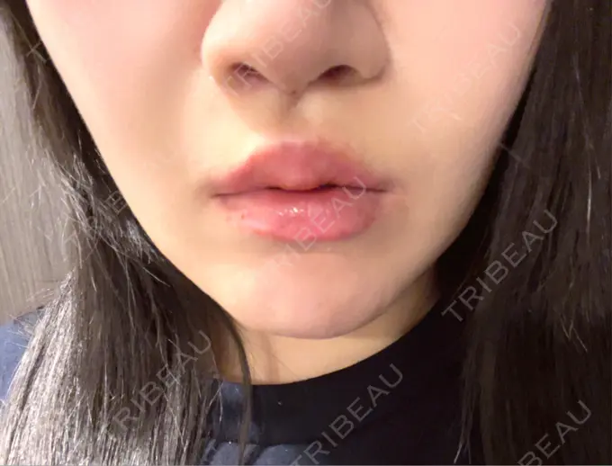 人中短縮 / 鼻柱下降・鼻唇角形成（猫手術） / その他（鼻） Otus Clinic 【オータスクリニック】 DAY 11 メイン用