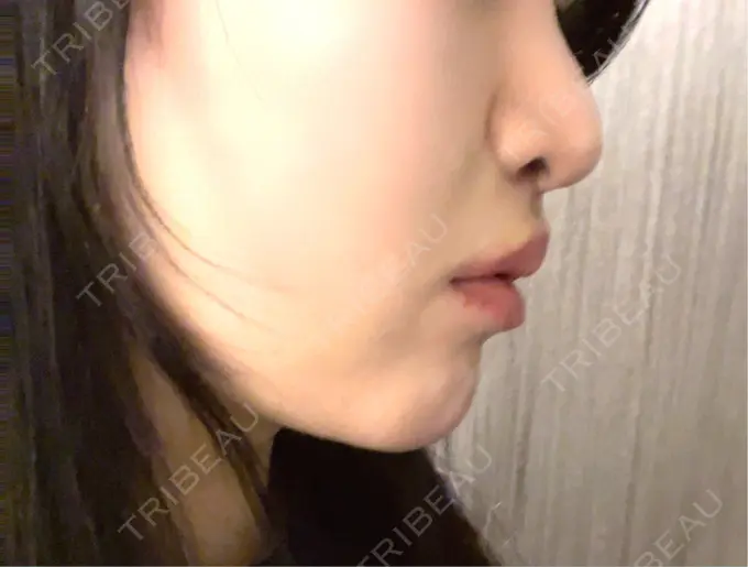 人中短縮 / 鼻柱下降・鼻唇角形成（猫手術） / その他（鼻） Otus Clinic 【オータスクリニック】 DAY 11 メイン用