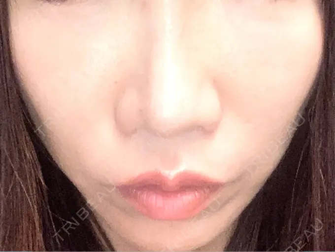 ボトックス（エラ・小顔） / ヴェルヴェットスキン おおたかの森ビューティークリニック AFTER メイン用