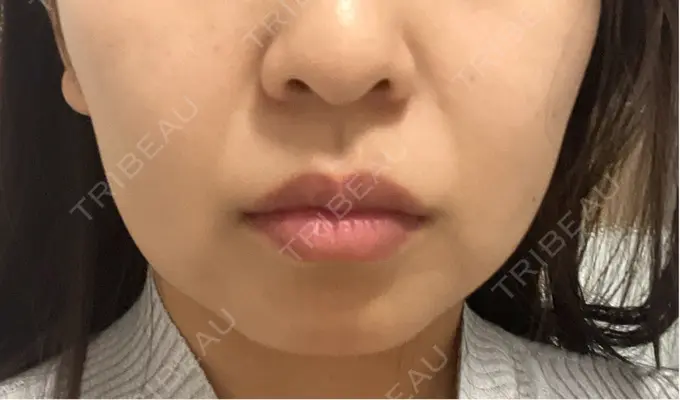 RF（高周波）たるみ治療 BISIN GINZA CLINIC DAY 3 メイン用