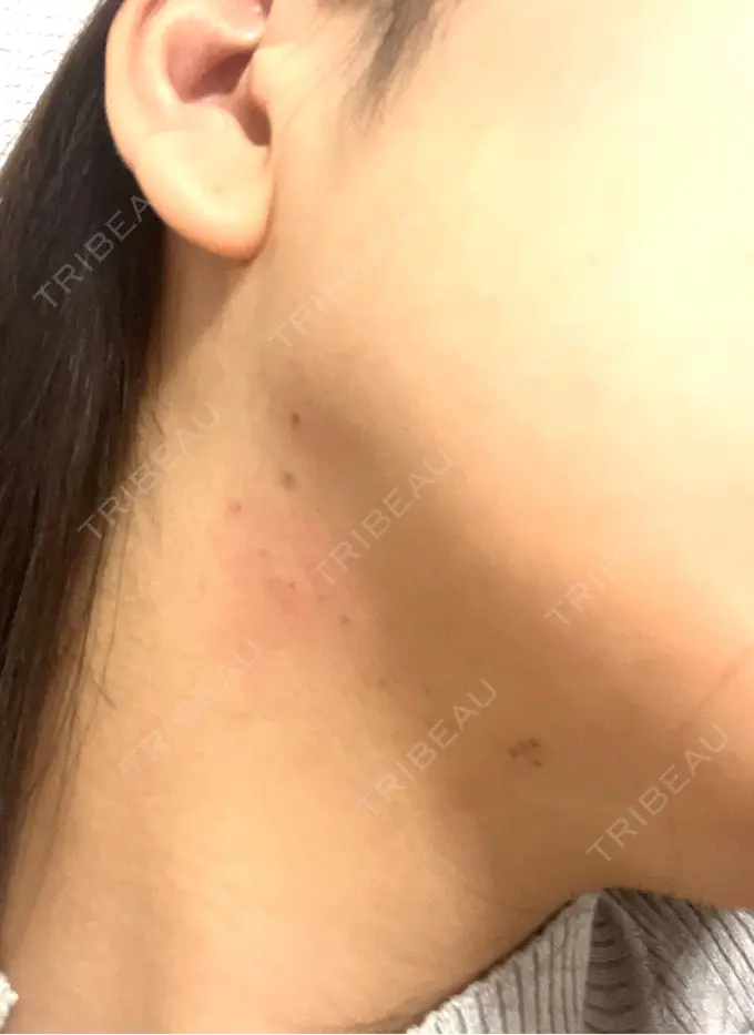 RF（高周波）たるみ治療 BISIN GINZA CLINIC DAY 3 メイン用