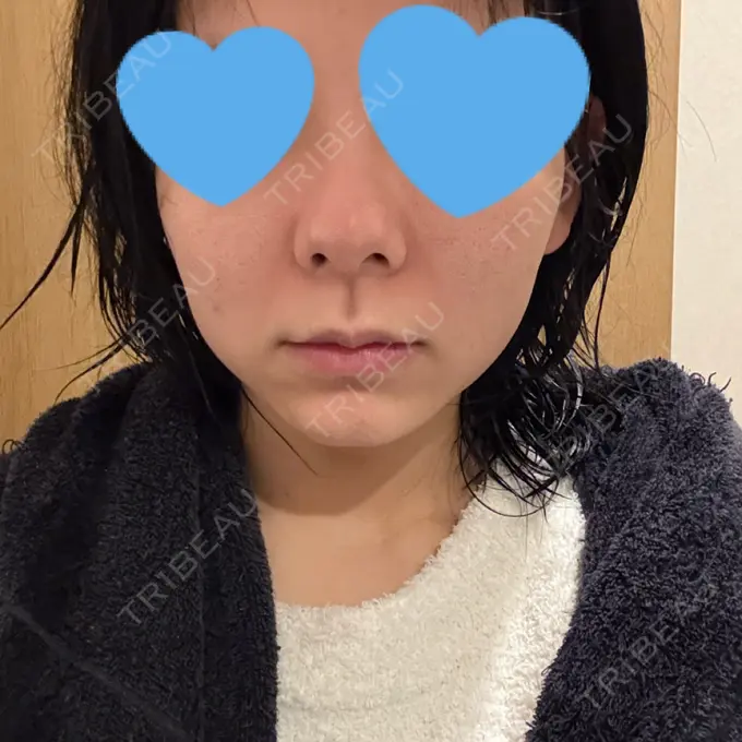 ヒアルロン酸注入（鼻） / ボトックス（エラ・小顔） / ヒアルロン酸注入（唇） / 美容点滴・美容注射（美肌） / ヒアルロン酸注入（鼻翼基部） HAAB BEAUTY CLINIC 名古屋院 DAY 4 メイン用