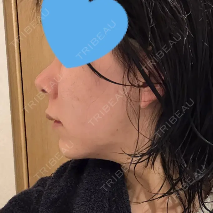 ヒアルロン酸注入（鼻） / ボトックス（エラ・小顔） / ヒアルロン酸注入（唇） / 美容点滴・美容注射（美肌） / ヒアルロン酸注入（鼻翼基部） HAAB BEAUTY CLINIC 名古屋院 DAY 4 メイン用