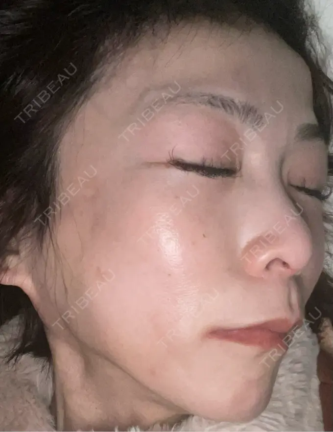 ボトックス（エラ・小顔） TCB東京中央美容外科 神戸院 DAY 8 メイン用