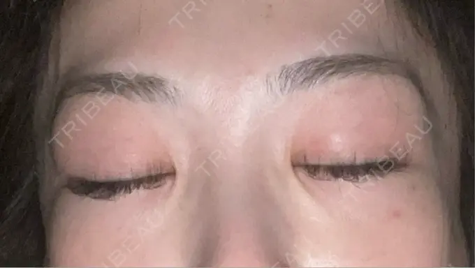 シワ取りボトックス TCB東京中央美容外科 神戸院 DAY 4 メイン用