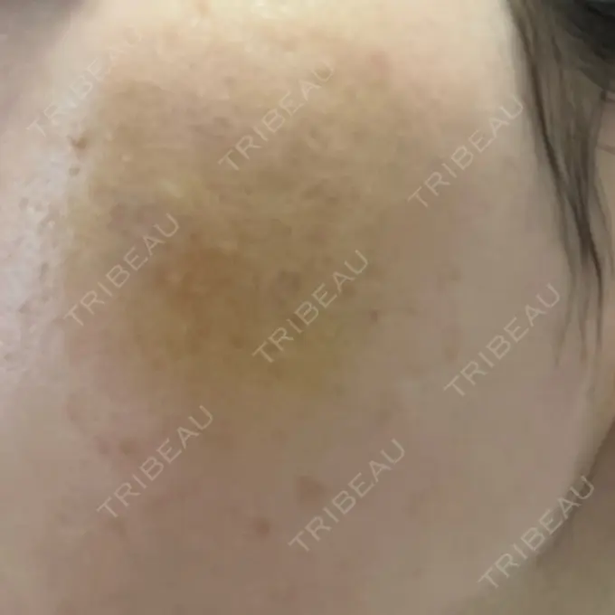 サブシジョン / 肌育注射（ジュベルックなど） / その他（肌） ゆきスキンクリニック 東池袋 DAY 6 メイン用