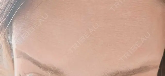 ボトックス（額） TCB東京中央美容外科 町田院 DAY 5 メイン用