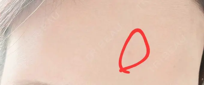 ボトックス（額） TCB東京中央美容外科 町田院 DAY 7 メイン用