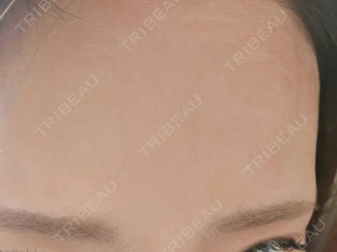 ボトックス（額） TCB東京中央美容外科 町田院 DAY 21 メイン用