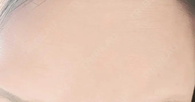 ボトックス（額） TCB東京中央美容外科 町田院 DAY 28 メイン用