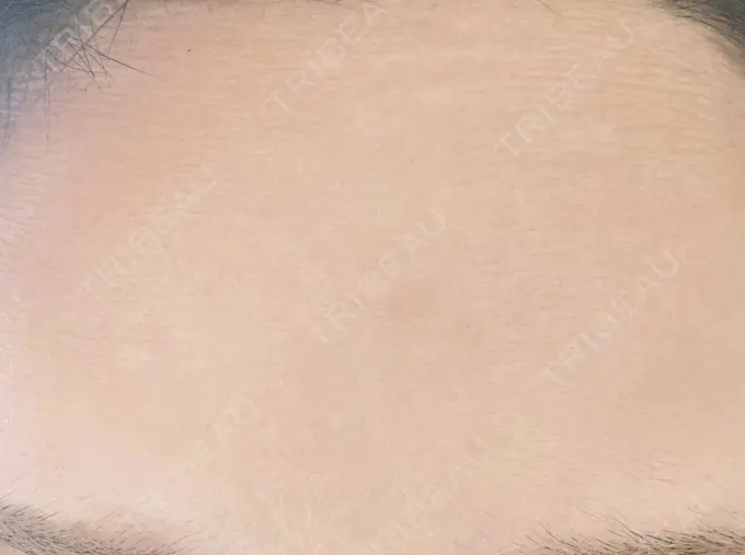 ボトックス（額） TCB東京中央美容外科 町田院 AFTER メイン用