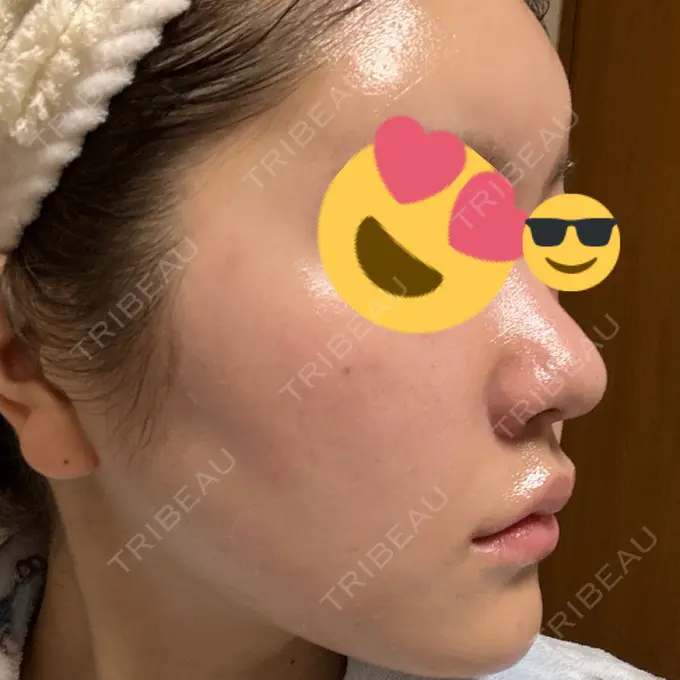 ヒアルロン酸注入（鼻翼基部） THE FIRST CLINIC 町田院 AFTER メイン用