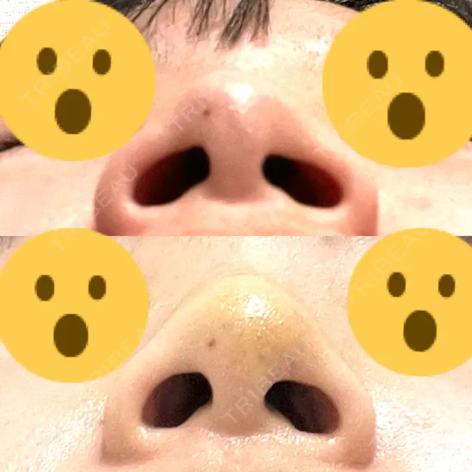 軟骨移植 R.O.clinic DAY 6 メイン用