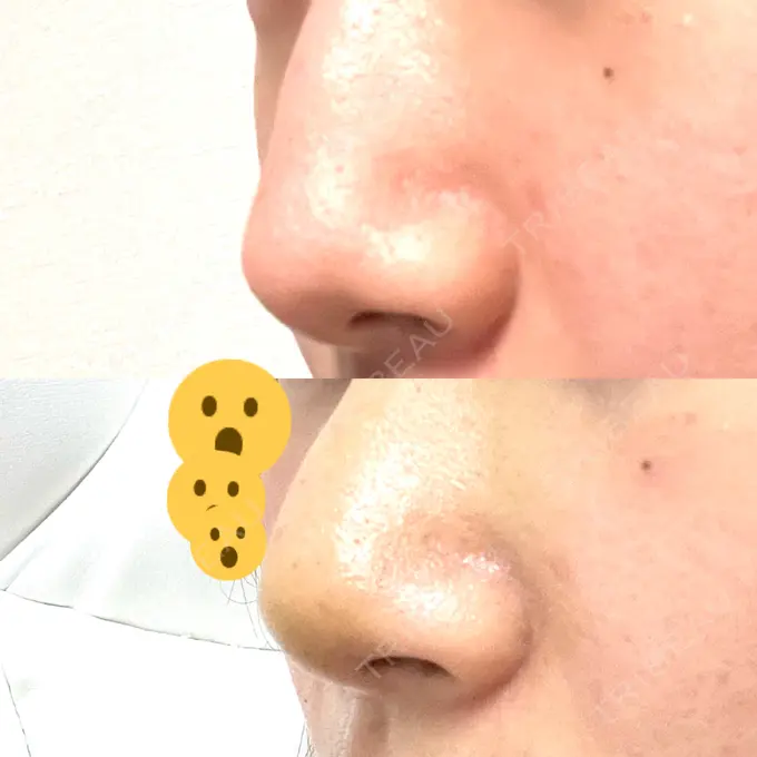 軟骨移植 R.O.clinic DAY 6 メイン用