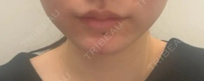 ボトックス（あご） / ヒアルロン酸注入（あご） PRO CLINIC プロクリニック 銀座院 AFTER メイン用