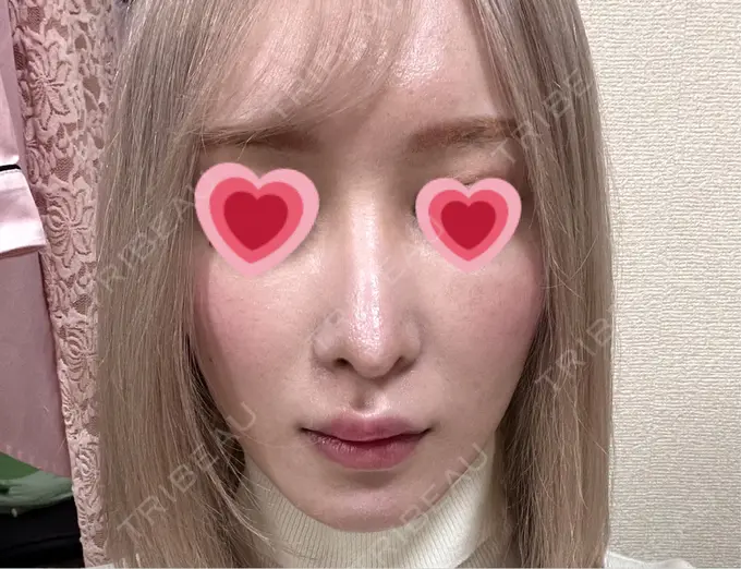 鼻尖形成（切開） / 軟骨移植 / 骨切幅寄せ / ワシ鼻修正・ハンプ切除 銀座マイアミ美容外科 AFTER メイン用