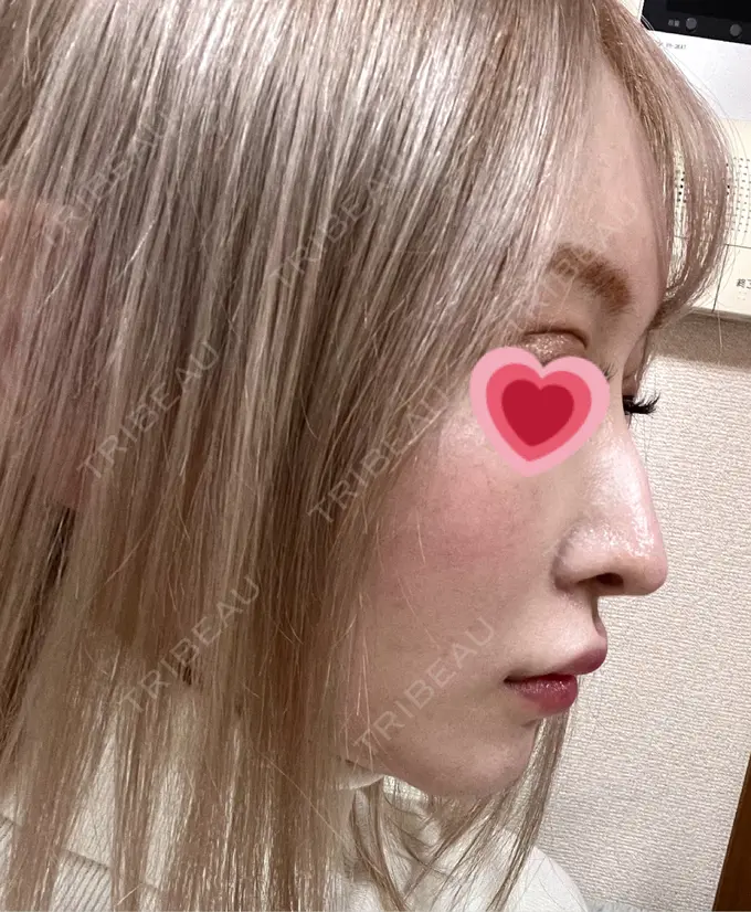 鼻尖形成（切開） / 軟骨移植 / 骨切幅寄せ / ワシ鼻修正・ハンプ切除 銀座マイアミ美容外科 DAY 258 メイン用