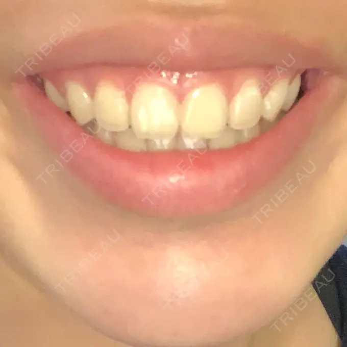 ガミースマイル手術 有楽町美容外科クリニック DAY 1 メイン用