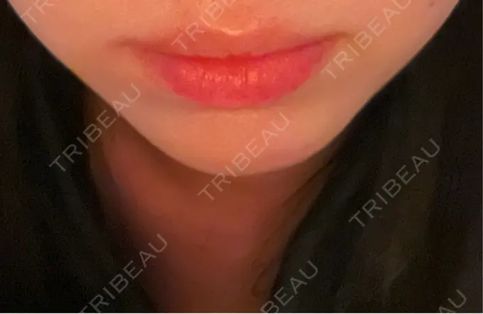 ヒアルロン酸注入（あご） / ヒアルロン酸注入（唇） / ボトックス（口角） ルラ美容クリニック 高田馬場院 AFTER メイン用