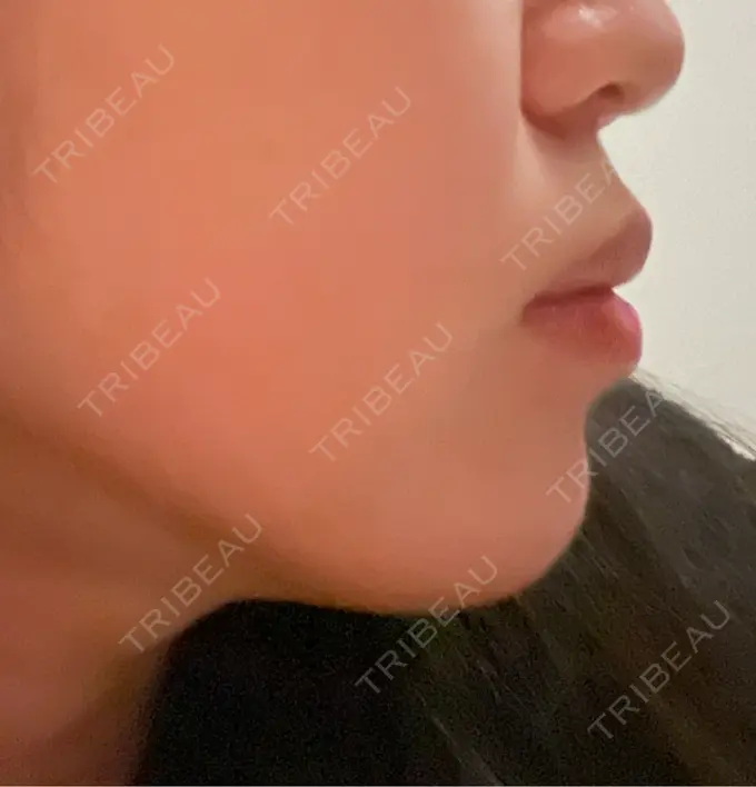 ヒアルロン酸注入（あご） / ヒアルロン酸注入（唇） / ボトックス（口角） ルラ美容クリニック 高田馬場院 DAY 32 メイン用