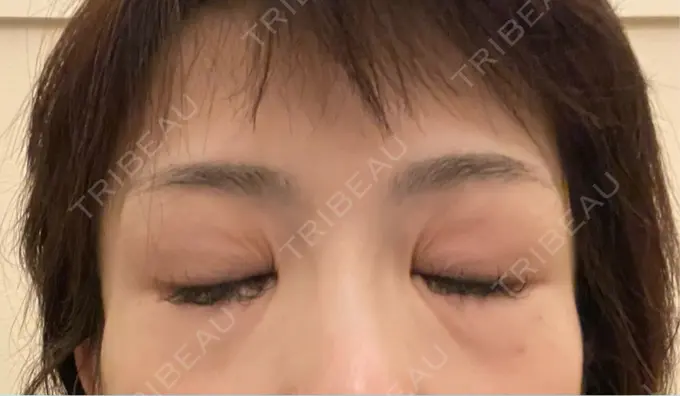 シワ取りボトックス TCB東京中央美容外科 神戸院 DAY 5 メイン用