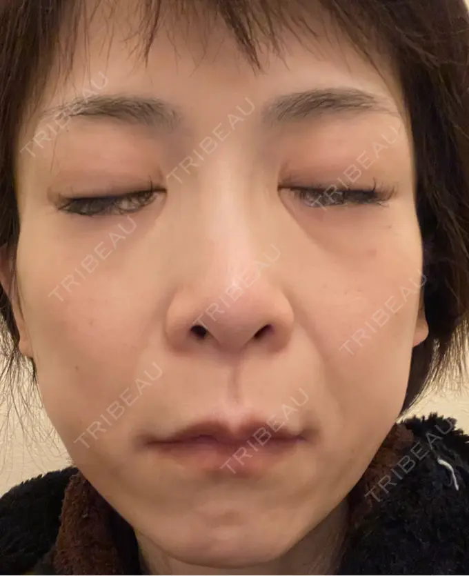 ボトックス（エラ・小顔） TCB東京中央美容外科 神戸院 DAY 9 メイン用