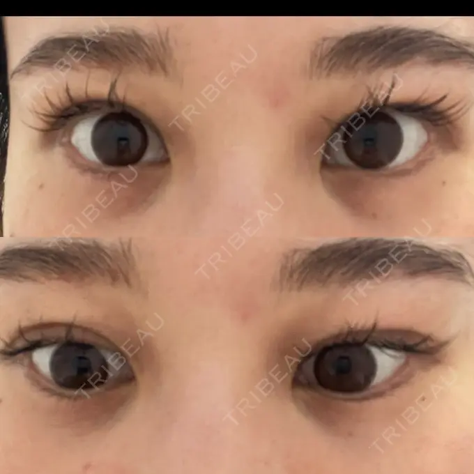 クマ治療 / 下まぶたの脂肪取り / その他（目元） ROOTS Clinic DAY 7 メイン用