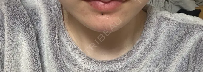 ボトックス（あご） / ヒアルロン酸注入（あご） PRO CLINIC プロクリニック 銀座院 DAY 1 メイン用