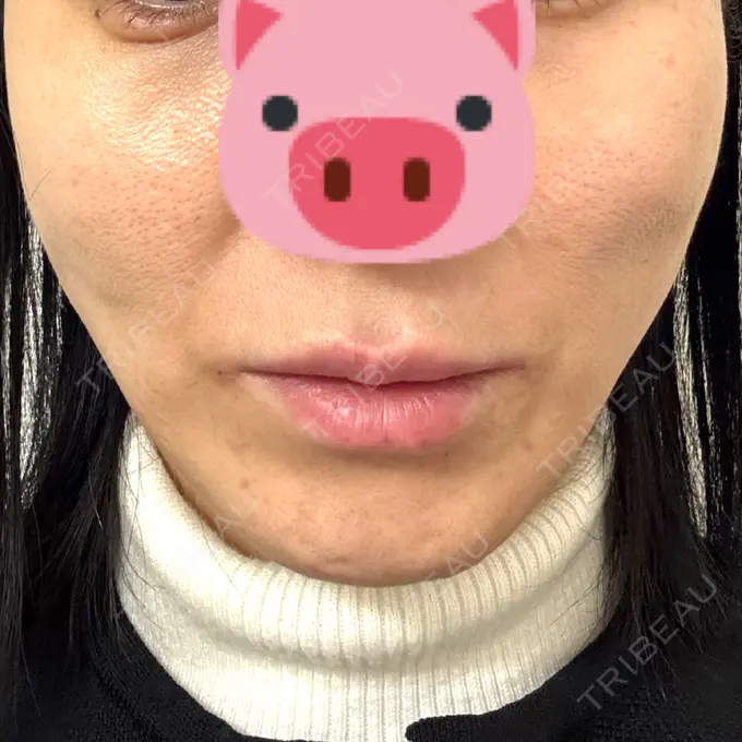 糸リフト Mods Clinic（モッズクリニック） 名古屋院 DAY 0 メイン用