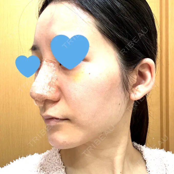 鼻尖形成（切開） / 鼻中隔延長（切開） / 軟骨移植 / 骨切幅寄せ / ワシ鼻修正・ハンプ切除 WOM CLINIC GINZA （ワム クリニック ギンザ） DAY 14 メイン用