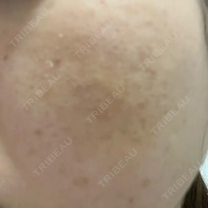 サブシジョン / 肌育注射（ジュベルックなど） / その他（肌） ゆきスキンクリニック 東池袋 DAY 7 メイン用