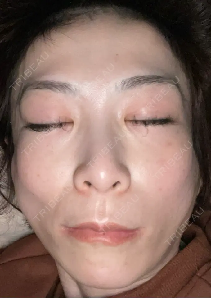 ボトックス（エラ・小顔） TCB東京中央美容外科 神戸院 AFTER メイン用