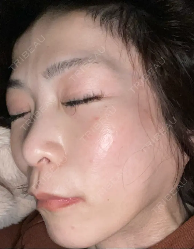 ボトックス（エラ・小顔） TCB東京中央美容外科 神戸院 DAY 10 メイン用