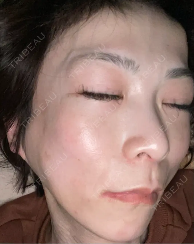 ボトックス（エラ・小顔） TCB東京中央美容外科 神戸院 DAY 10 メイン用