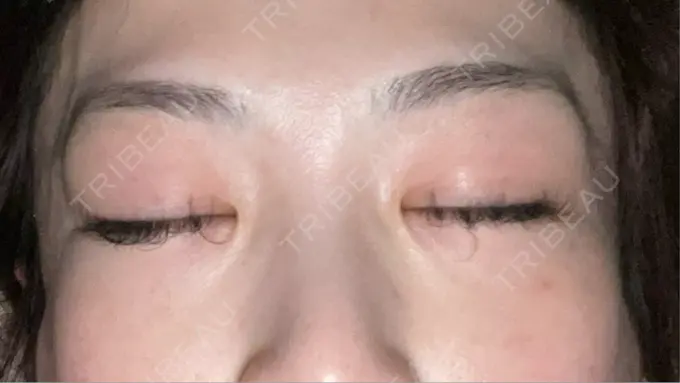 シワ取りボトックス TCB東京中央美容外科 神戸院 DAY 6 メイン用