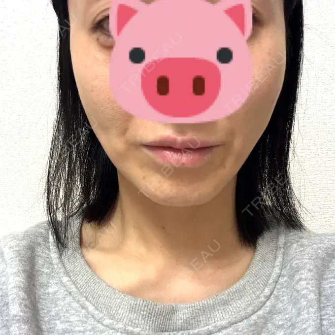 糸リフト Mods Clinic（モッズクリニック） 名古屋院 DAY 1 メイン用