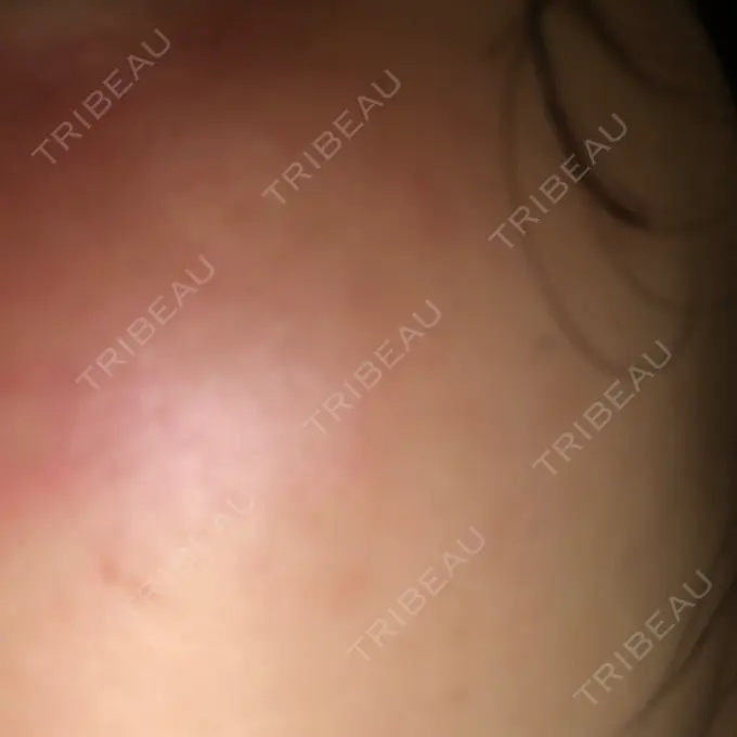 ピーリング（ニキビ・毛穴） / ピコレーザートーニング（美白・肝斑） 日本美容・医療クリニック 六本木院 AFTER メイン用