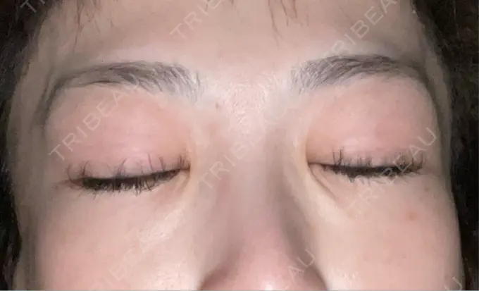 シワ取りボトックス TCB東京中央美容外科 神戸院 DAY 7 メイン用