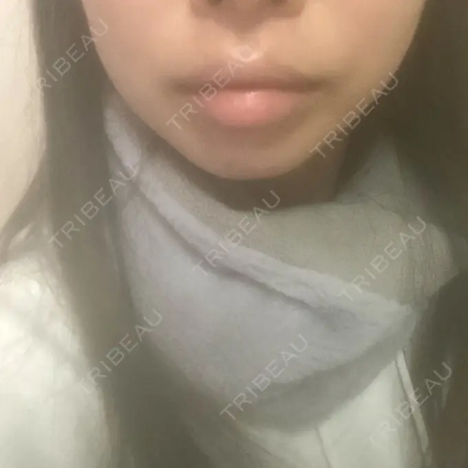 人中短縮 / ボトックス（人中） 新宿ラクル美容外科クリニック 新宿院 AFTER メイン用