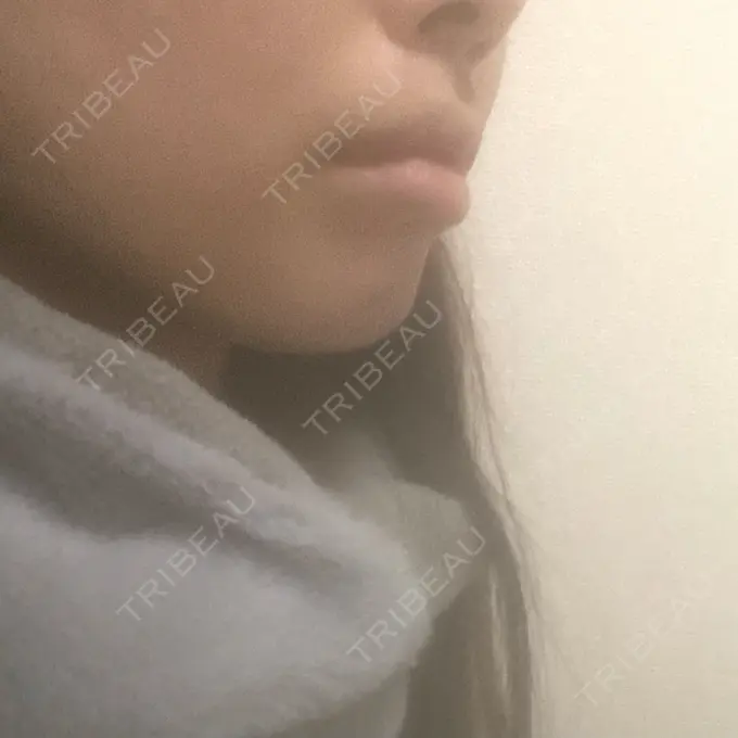 人中短縮 / ボトックス（人中） 新宿ラクル美容外科クリニック 新宿院 DAY 205 メイン用