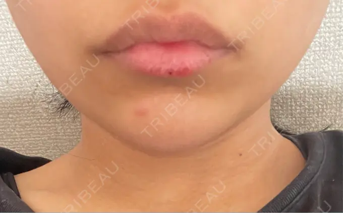 ボトックス（エラ・小顔） L‘amour clinic Tokyo【ラムールクリニック東京】 DAY 0 メイン用