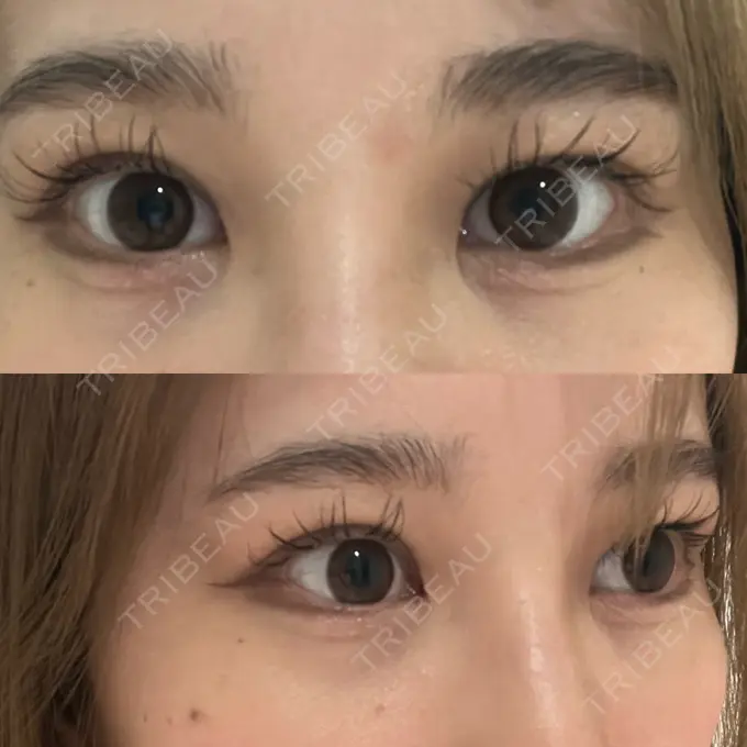 クマ治療 / 下まぶたの脂肪取り / その他（目元） ROOTS Clinic DAY 9 メイン用