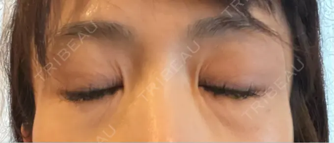 シワ取りボトックス TCB東京中央美容外科 神戸院 DAY 8 メイン用