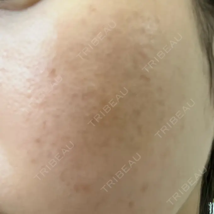 サブシジョン / 肌育注射（ジュベルックなど） / その他（肌） ゆきスキンクリニック 東池袋 DAY 10 メイン用