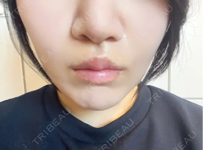 人中短縮 / 鼻柱下降・鼻唇角形成（猫手術） / その他（鼻） Otus Clinic 【オータスクリニック】 DAY 16 メイン用