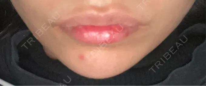 ボトックス（エラ・小顔） L‘amour clinic Tokyo【ラムールクリニック東京】 DAY 2 メイン用