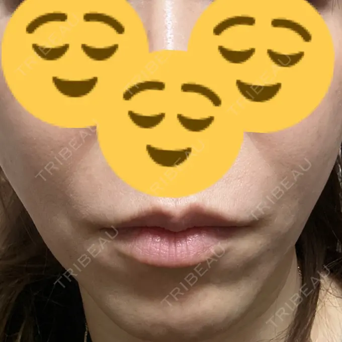 糸リフト DMTC CLINIC 日本橋院 DAY 17 メイン用