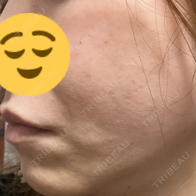 糸リフト DMTC CLINIC 日本橋院 DAY 17 メイン用