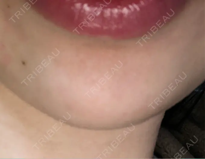 ボトックス（あご） / ボトックス（眉間） 湘南美容クリニック 博多院 AFTER メイン用