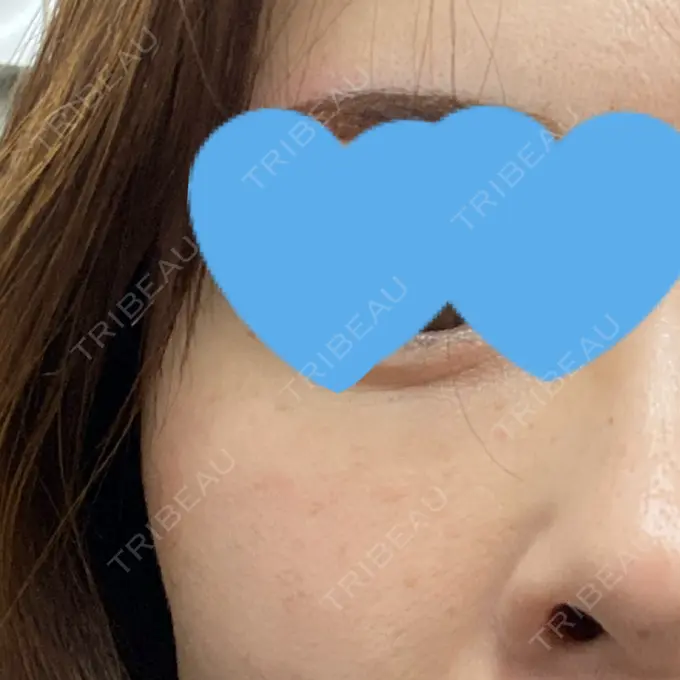 イオン導入 / 毛穴洗浄（ハイドラフェイシャルなど） / ルメッカ ルラ美容クリニック 渋谷本院 AFTER メイン用